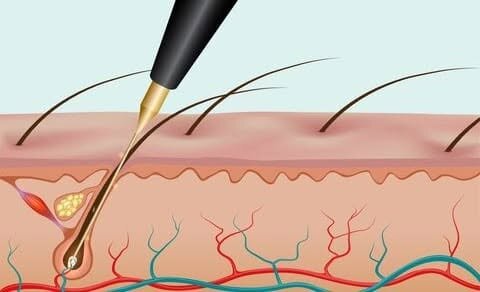 Ilustracija: sonda za elektrolizu prodire do korena dlačice
